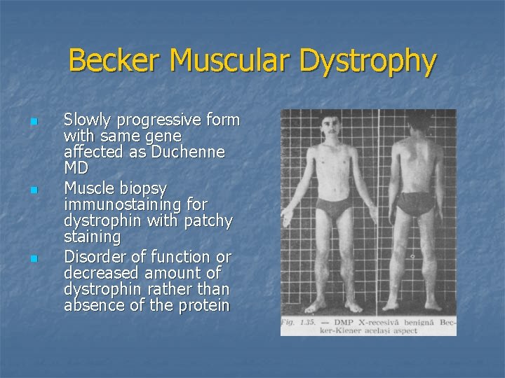 Becker Muscular Dystrophy n n n Slowly progressive form with same gene affected as