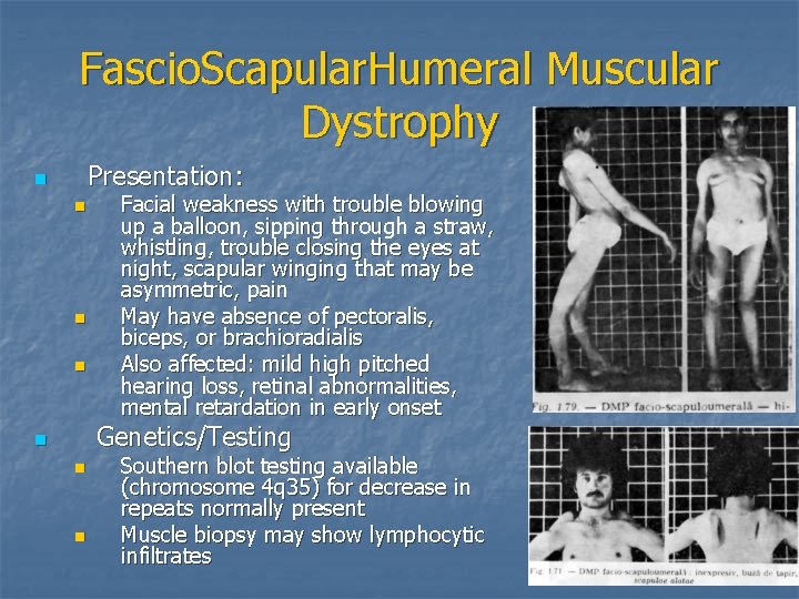 Fascio. Scapular. Humeral Muscular Dystrophy Presentation: n n Facial weakness with trouble blowing up