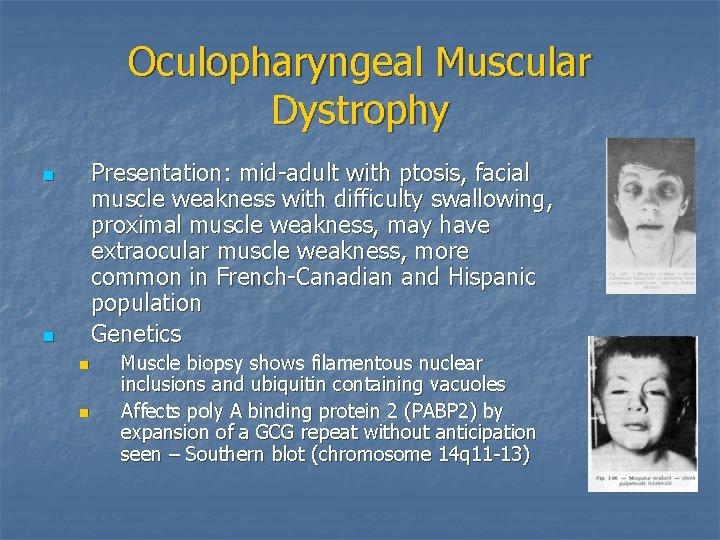 Oculopharyngeal Muscular Dystrophy Presentation: mid-adult with ptosis, facial muscle weakness with difficulty swallowing, proximal