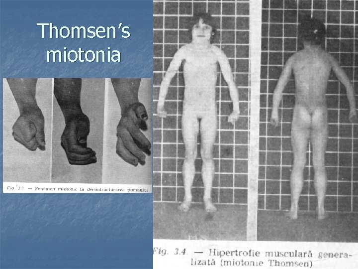 Thomsen’s miotonia 