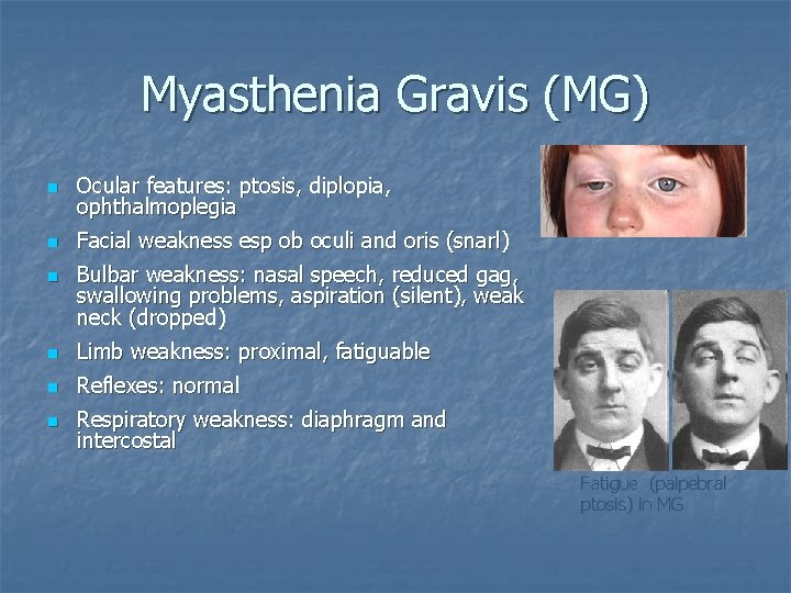 Myasthenia Gravis (MG) n Ocular features: ptosis, diplopia, ophthalmoplegia n Facial weakness esp ob