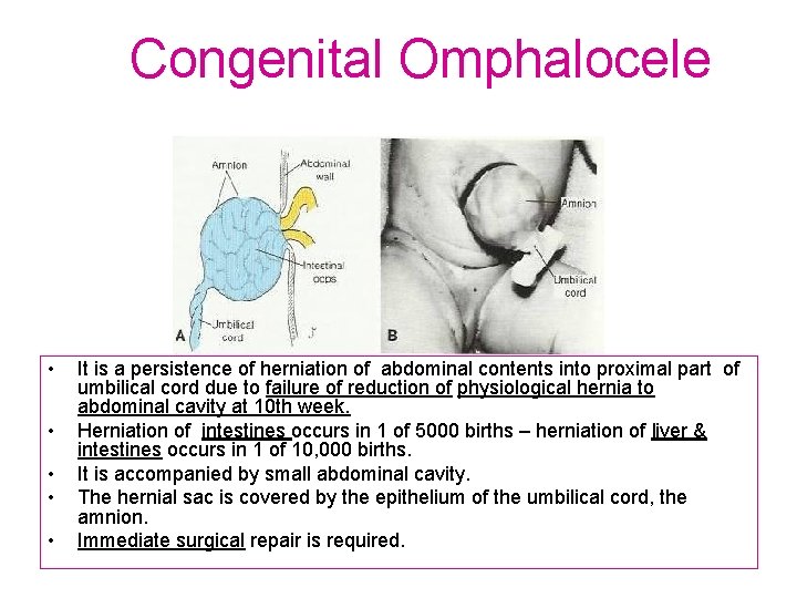 Congenital Omphalocele • • • It is a persistence of herniation of abdominal contents