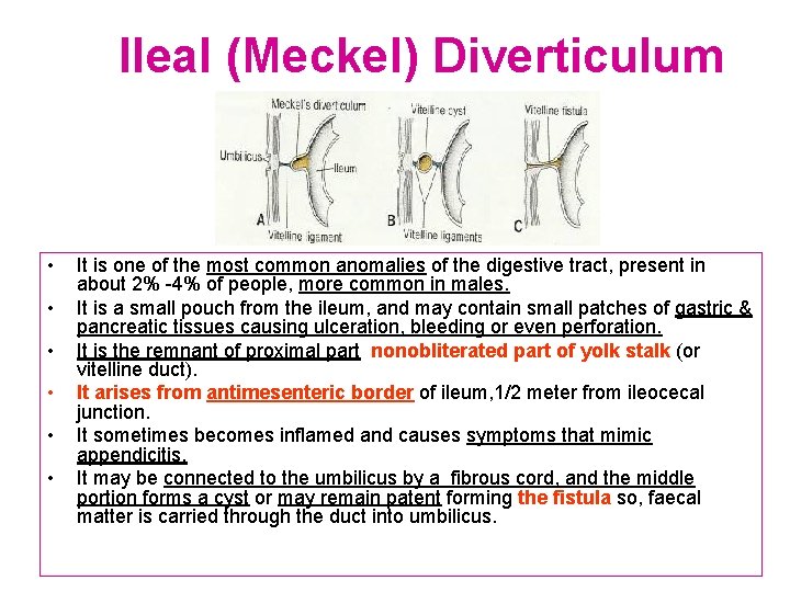 Ileal (Meckel) Diverticulum • • • It is one of the most common anomalies