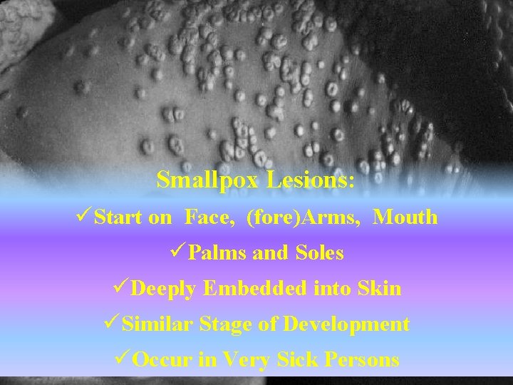 Smallpox Lesions: üStart on Face, (fore)Arms, Mouth üPalms and Soles üDeeply Embedded into Skin