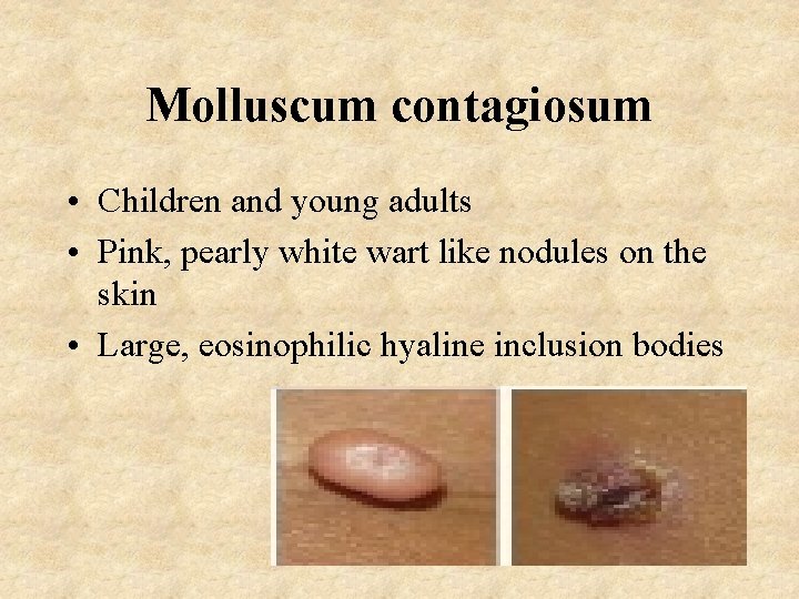 Molluscum contagiosum • Children and young adults • Pink, pearly white wart like nodules