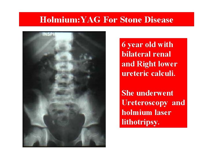 Holmium: YAG For Stone Disease 6 year old with bilateral renal and Right lower