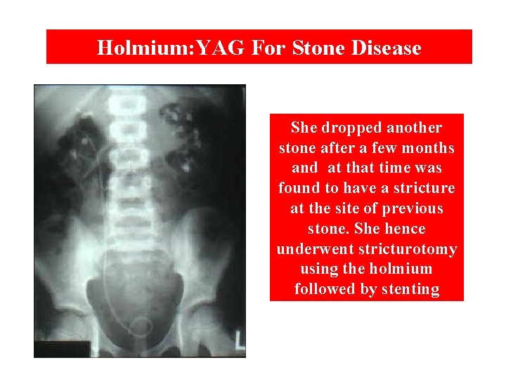 Holmium: YAG For Stone Disease She dropped another stone after a few months and