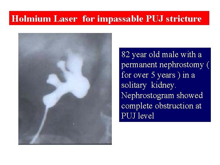 Holmium Laser for impassable PUJ stricture 82 year old male with a permanent nephrostomy