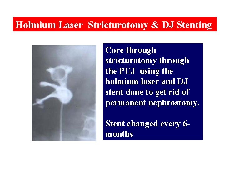 Holmium Laser Stricturotomy & DJ Stenting Core through stricturotomy through the PUJ using the