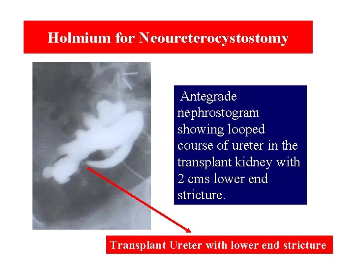 Holmium for Neoureterocystostomy Antegrade nephrostogram showing looped course of ureter in the transplant kidney