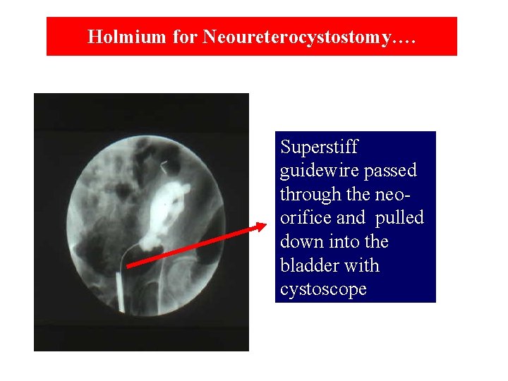 Holmium for Neoureterocystostomy…. Superstiff guidewire passed through the neoorifice and pulled down into the