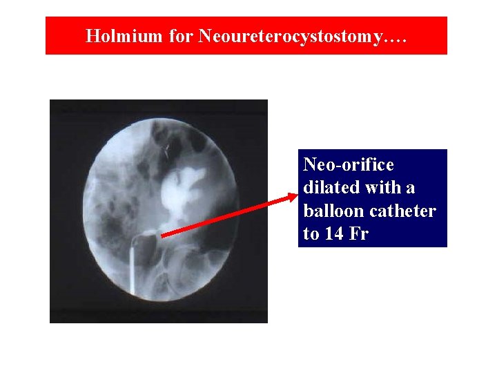 Holmium for Neoureterocystostomy…. Neo-orifice dilated with a balloon catheter to 14 Fr 