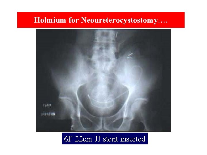 Holmium for Neoureterocystostomy…. 6 F 22 cm JJ stent inserted 