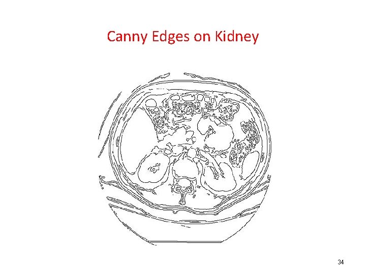 Canny Edges on Kidney 34 