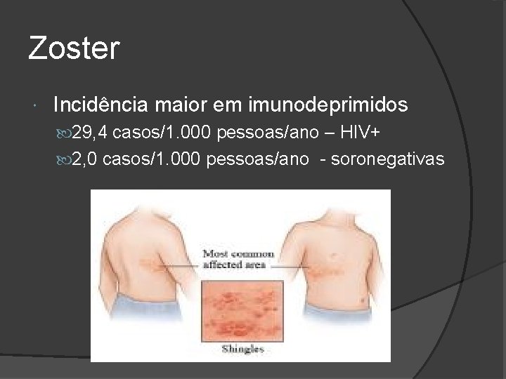 Zoster Incidência maior em imunodeprimidos 29, 4 casos/1. 000 pessoas/ano – HIV+ 2, 0