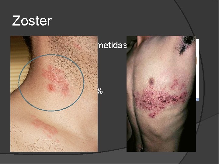 Zoster Regiões mais acometidas Torácica – 53% Cervical – 20% Trigêmeo – 15% Lombossacra