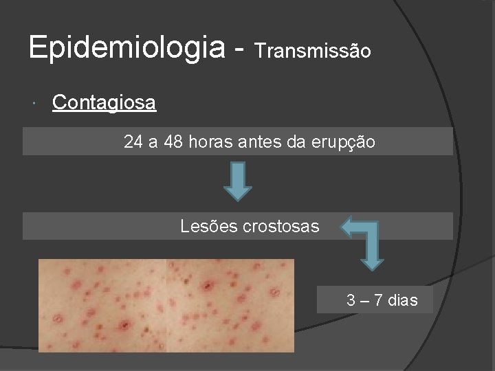 Epidemiologia - Transmissão Contagiosa 24 a 48 horas antes da erupção Lesões crostosas 3