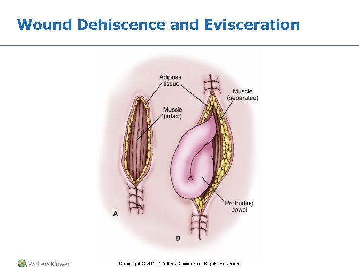 Wound Dehiscence and Evisceration Copyright © 2019 Wolters Kluwer • All Rights Reserved 