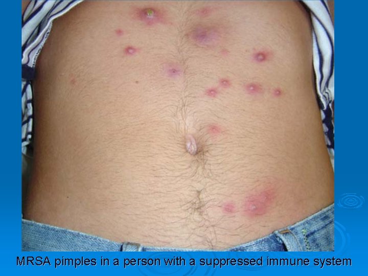 MRSA pimples in a person with a suppressed immune system 