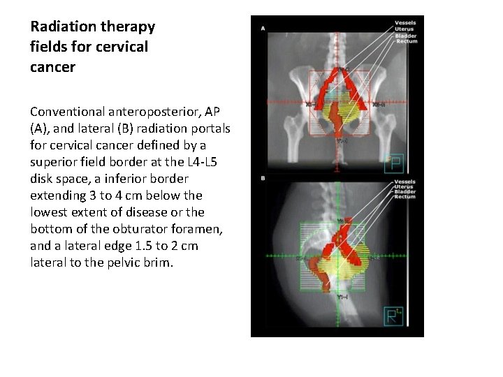 Radiation therapy fields for cervical cancer Conventional anteroposterior, AP (A), and lateral (B) radiation