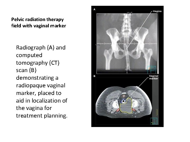 Pelvic radiation therapy field with vaginal marker Radiograph (A) and computed tomography (CT) scan