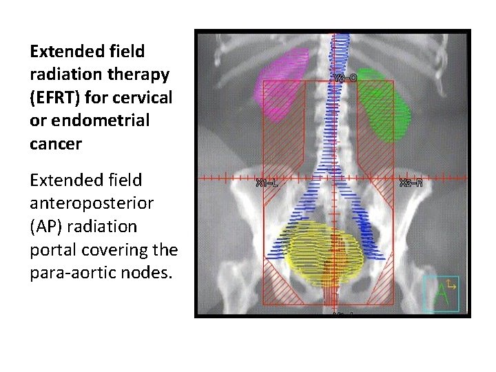Extended field radiation therapy (EFRT) for cervical or endometrial cancer Extended field anteroposterior (AP)