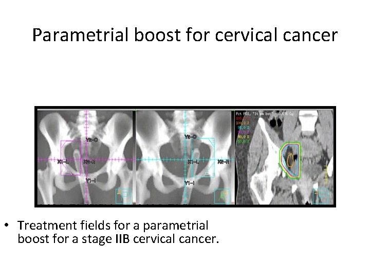 Parametrial boost for cervical cancer • Treatment fields for a parametrial boost for a