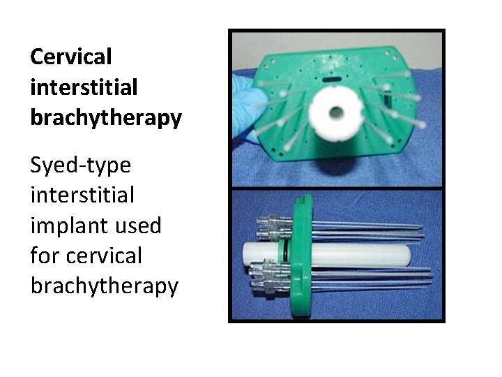 Cervical interstitial brachytherapy Syed-type interstitial implant used for cervical brachytherapy 