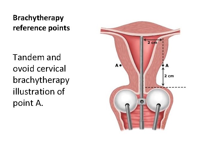 Brachytherapy reference points Tandem and ovoid cervical brachytherapy illustration of point A. 