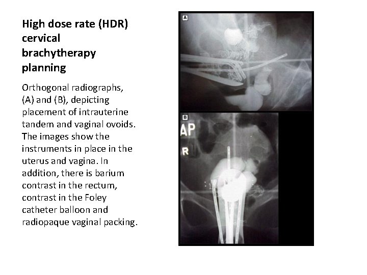 High dose rate (HDR) cervical brachytherapy planning Orthogonal radiographs, (A) and (B), depicting placement