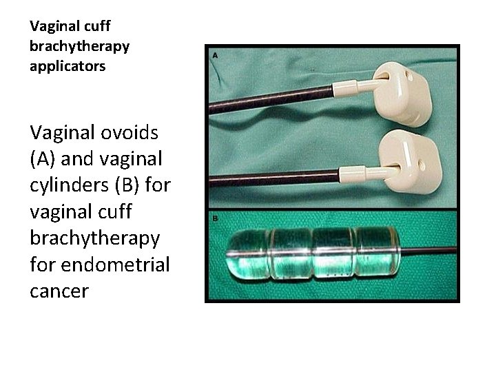 Vaginal cuff brachytherapy applicators Vaginal ovoids (A) and vaginal cylinders (B) for vaginal cuff