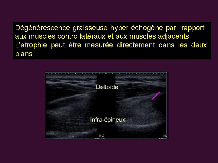 Dégénérescence graisseuse hyper échogène par rapport aux muscles contro latéraux et aux muscles adjacents