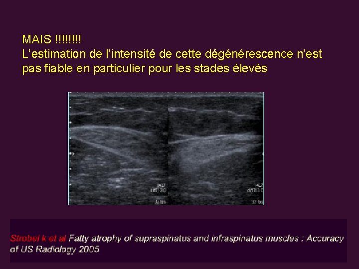 MAIS !!!! L’estimation de l’intensité de cette dégénérescence n’est pas fiable en particulier pour