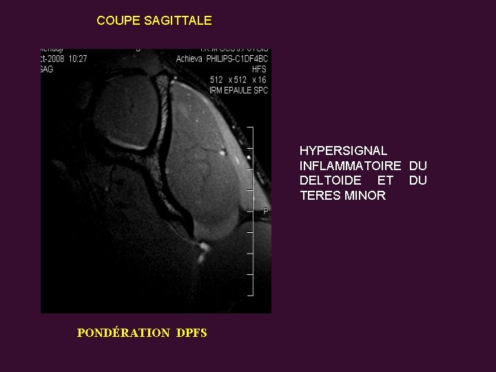 COUPE SAGITTALE HYPERSIGNAL INFLAMMATOIRE DU DELTOIDE ET DU TERES MINOR PONDÉRATION DPFS 