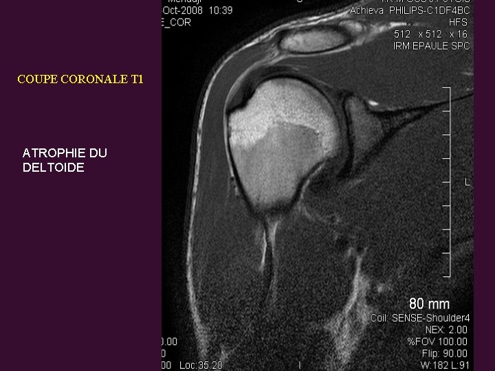 COUPE CORONALE T 1 ATROPHIE DU DELTOIDE 