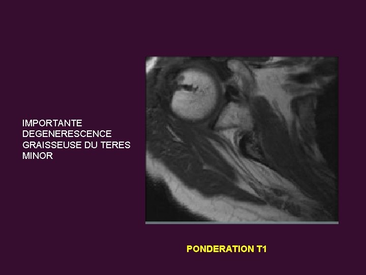 IMPORTANTE DEGENERESCENCE GRAISSEUSE DU TERES MINOR PONDERATION T 1 