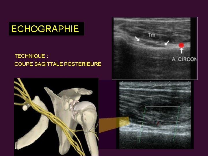 ECHOGRAPHIE TECHNIQUE : COUPE SAGITTALE POSTERIEURE 