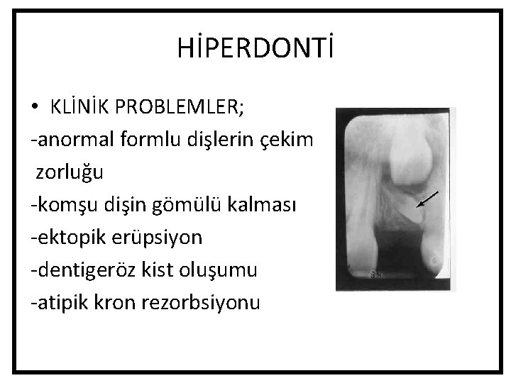 HİPERDONTİ • KLİNİK PROBLEMLER; -anormal formlu dişlerin çekim zorluğu -komşu dişin gömülü kalması -ektopik HİPERDONTİ • KLİNİK PROBLEMLER; -anormal formlu dişlerin çekim zorluğu -komşu dişin gömülü kalması -ektopik