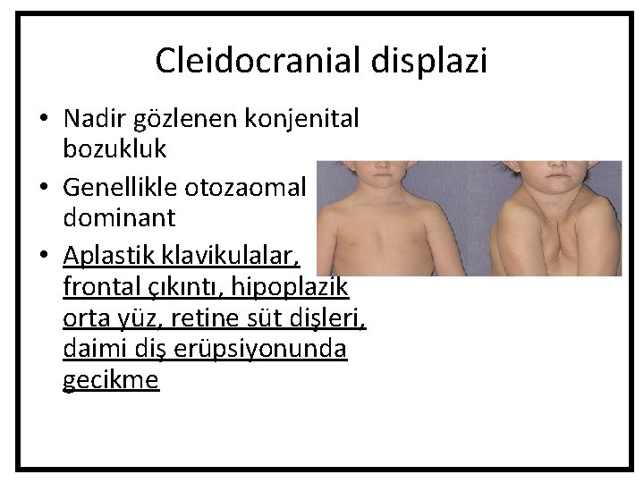 Cleidocranial displazi • Nadir gözlenen konjenital bozukluk • Genellikle otozaomal dominant • Aplastik klavikulalar, Cleidocranial displazi • Nadir gözlenen konjenital bozukluk • Genellikle otozaomal dominant • Aplastik klavikulalar,