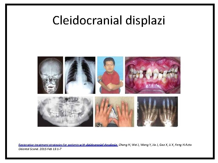Cleidocranial displazi Restorative treatment strategies for patients with cleidocranial dysplasia. Chang H, Wei J, Cleidocranial displazi Restorative treatment strategies for patients with cleidocranial dysplasia. Chang H, Wei J,
