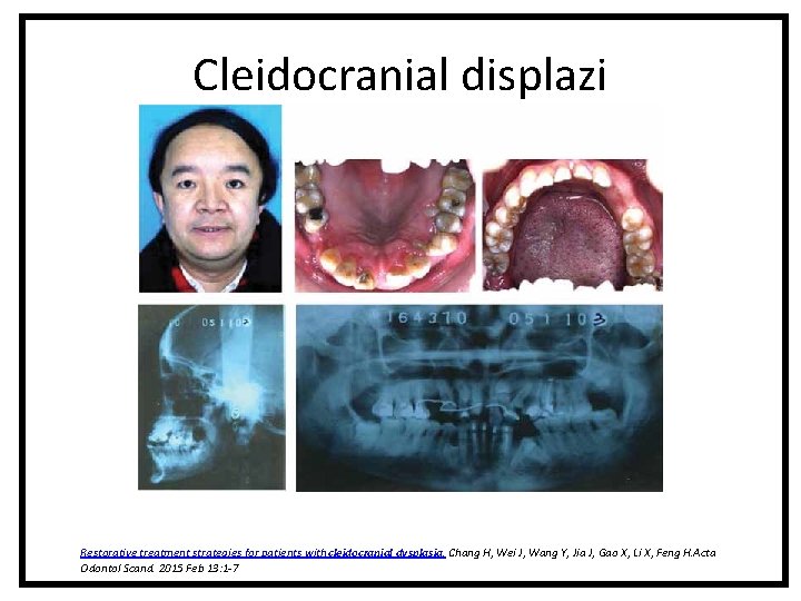 Cleidocranial displazi Restorative treatment strategies for patients with cleidocranial dysplasia. Chang H, Wei J, Cleidocranial displazi Restorative treatment strategies for patients with cleidocranial dysplasia. Chang H, Wei J,