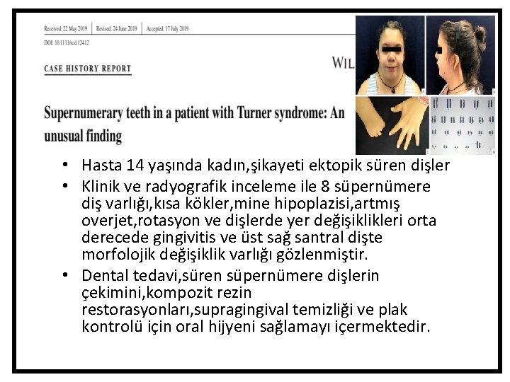 • Hasta 14 yaşında kadın, şikayeti ektopik süren dişler • Klinik ve radyografik • Hasta 14 yaşında kadın, şikayeti ektopik süren dişler • Klinik ve radyografik