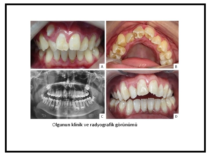 Olgunun klinik ve radyografik görünümü Olgunun klinik ve radyografik görünümü