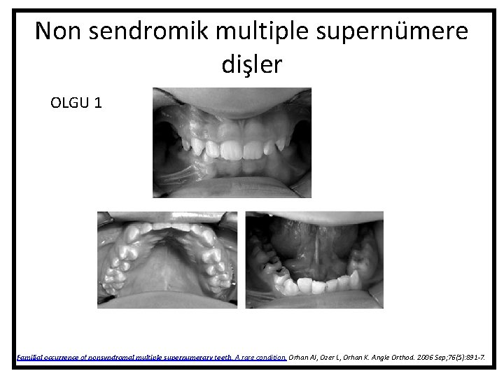 Non sendromik multiple supernümere dişler OLGU 1 Familial occurrence of nonsyndromal multiple supernumerary teeth. Non sendromik multiple supernümere dişler OLGU 1 Familial occurrence of nonsyndromal multiple supernumerary teeth.