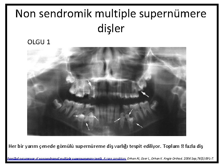 Non sendromik multiple supernümere dişler OLGU 1 Her bir yarım çenede gömülü supernüreme diş Non sendromik multiple supernümere dişler OLGU 1 Her bir yarım çenede gömülü supernüreme diş