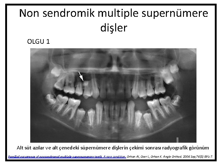 Non sendromik multiple supernümere dişler OLGU 1 Alt süt azılar ve alt çenedeki süpernümere Non sendromik multiple supernümere dişler OLGU 1 Alt süt azılar ve alt çenedeki süpernümere