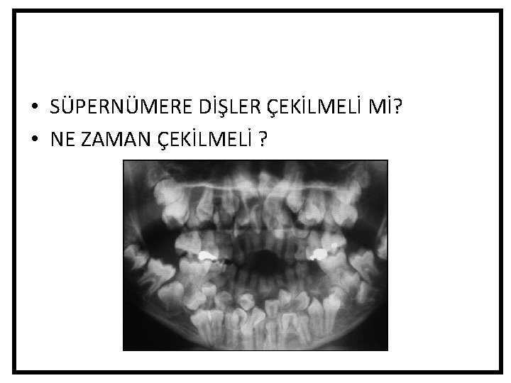 • SÜPERNÜMERE DİŞLER ÇEKİLMELİ Mİ? • NE ZAMAN ÇEKİLMELİ ? • SÜPERNÜMERE DİŞLER ÇEKİLMELİ Mİ? • NE ZAMAN ÇEKİLMELİ ?