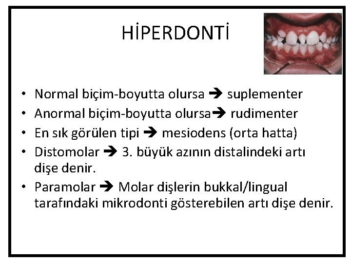 HİPERDONTİ Normal biçim-boyutta olursa suplementer Anormal biçim-boyutta olursa rudimenter En sık görülen tipi mesiodens HİPERDONTİ Normal biçim-boyutta olursa suplementer Anormal biçim-boyutta olursa rudimenter En sık görülen tipi mesiodens