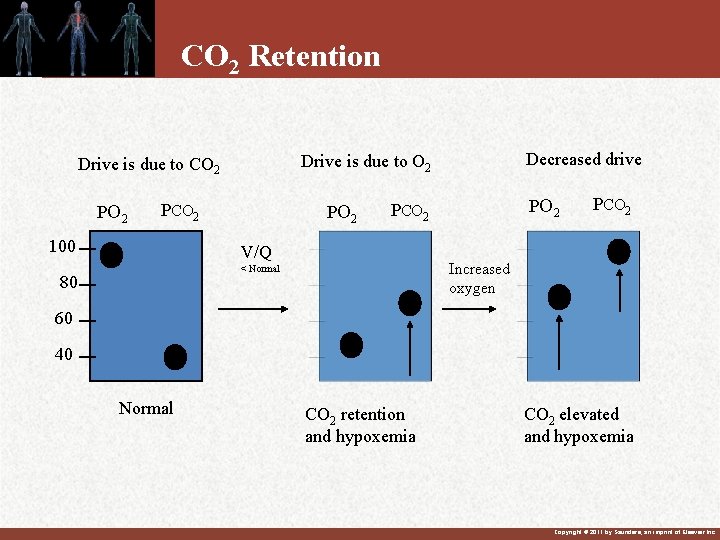 CO 2 Retention PO 2 PCO 2 100 PO 2 PCO 2 V/Q PCO