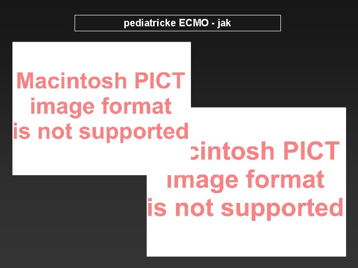 pediatricke ECMO - jak 